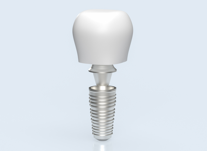 Modèle d'implant dentaire en titane avec couronne